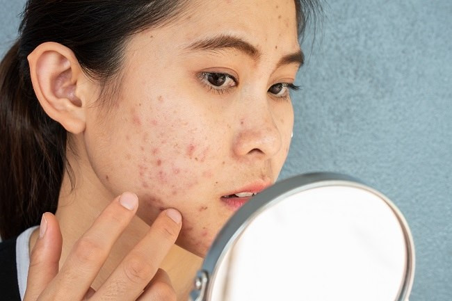Apa Kata Jerawatmu? Mengungkap Rahasia Posisi Jerawat dan Kesehatan Tubuh