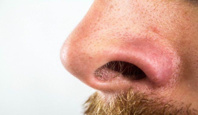 7 Hari Hempas Komedo di Hidung, Bikin Lebih Pede