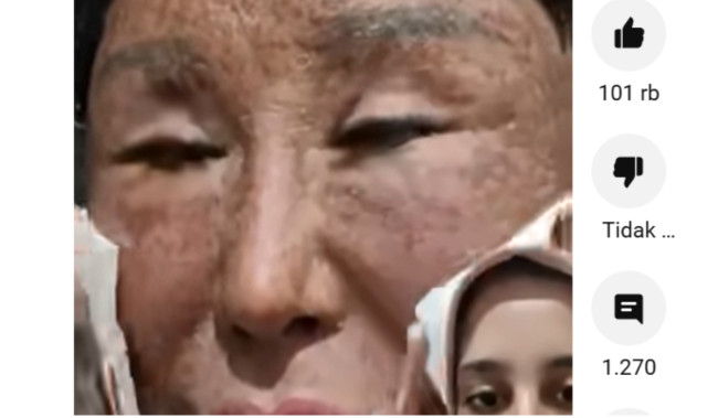 Viral! Kondisi Kulit Ibu-Ibu Ini Bikin Ngeri: Pasca Treatment Kulit Mengelupas