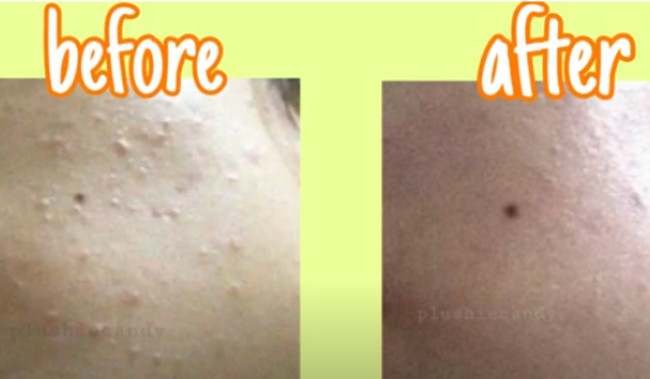 DIY SKINCARE: Toner dan Masker Wajah Alami Ampuh Hempas Beruntusan