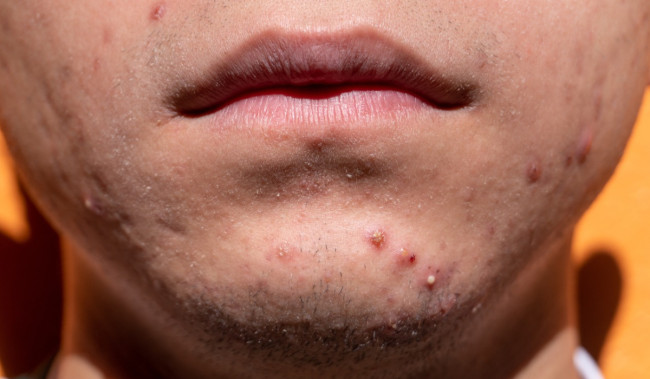 Rajin Pakai Skincare, Tapi Masih Timbul Jerawat? Bisa Jadi Ini Penyebabnya