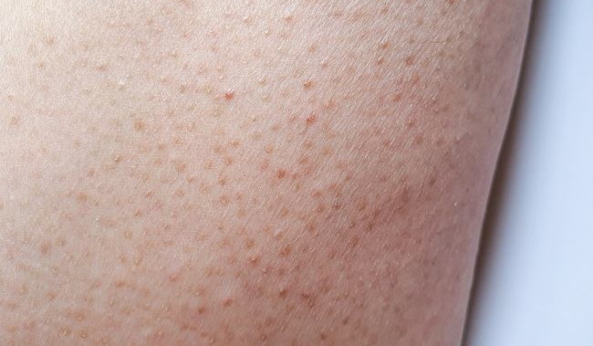 Cara Efektif Mengatasi Keratosis Pilaris: Tips untuk Kulit Lebih Halus