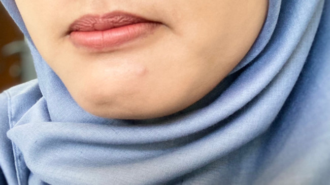 Cara Tepat Atasi Jerawat Sesuai Tipe: Pilih Serum atau Obat Dokter?