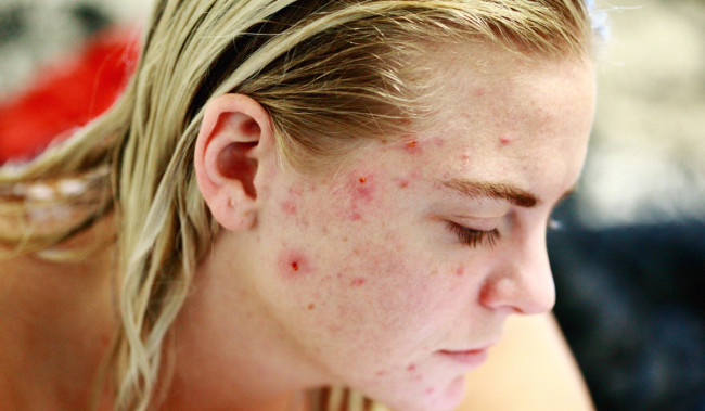 4 Kesalahan Skincare Rutin yang Bikin Jerawat Semakin Parah