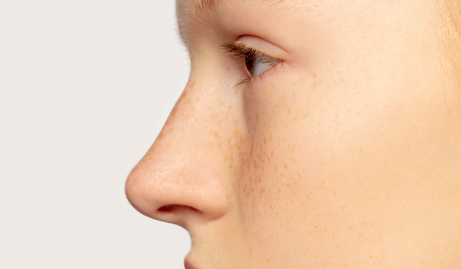 Skincare untuk Hempaskan Komedo Membandel di Hidung