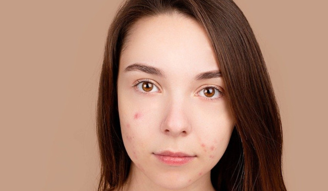 Tipe-Tipe Jerawat dan Cara Mengatasinya, Ilmu Daging Nih Buat Acne Fighter