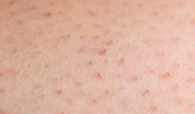 Bebas Rambut Tumbuh ke Dalam: Solusi Nyaman untuk Kulit Halus dengan IPL