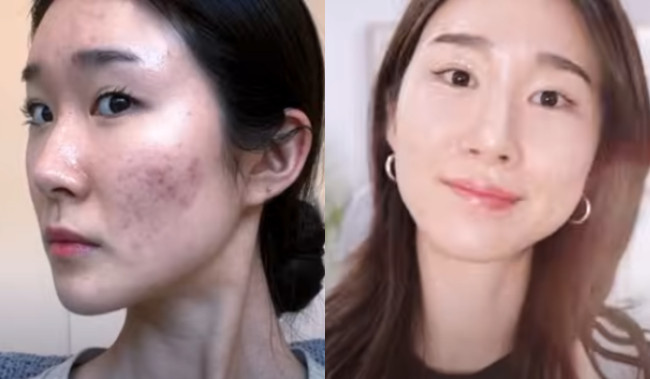 Wanita Ini Bagikan Cara Atasi Jerawat, Bukan Skincare tapi Ampuh Bikin Kulit Mulus