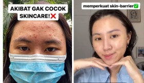SKINCARE JERAWAT - Trik pemakaian skincare saat kulit wajah sedang jerawat. Wanita ini bagikan pengalamannya. - Foto tangkap layar YouTube/christinaimmanuel