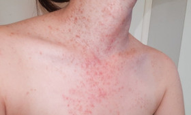 TIPS- Rahasia dr. Davin Lim Mengatasi Fungal Acne: Solusi Mudah untuk Masalah Kulit yang Sering Diabaikan (Sumber: https://www.alodokter.com/)