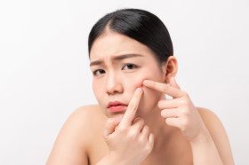 Jerawat di wajah. Simak cara membuat krim dengan bahan alami di rumah, bisa mengusir jerawat membandel. Ilustrasi/Freepik.