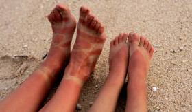 SUNBURN - Terkena paparan sinar UV matahari yang berlebih, bisa sebabkan sunburn. Kulit mengelupas dan terasa perih. - Foto ilustrasi/freepik.
