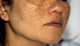 TIPS- Cara Alami Mengatasi Melasma: Pilihan Tepat untuk Kulit Sehat dan Aman Saat Hamil (Sumber: https://www.alodokter.com/)