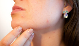 SKINCARE KULIT JERAWAT - Tidak perlu khawatir lagi dengan kulit jerawat, bisa diatasi dengan melakukan rutinitas skincare berikut ini. - Foto ilustrasi Pixabay/Kjerstin_Michaela.