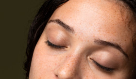 FLEK HITAM - Flek hitam yang muncul pada wajah, disebut juga dengan Melasma. Apakah bisa hilang? Dokter Arlini beri penjelasan lengkap. - Foto ilustrasi/freepik.
