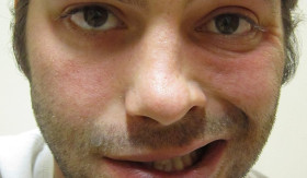 INFO- Waspadai Angin Dingin yang Bisa Memicu Bell’s Palsy pada Wajah (Sumber: https://id.wikipedia.org/)