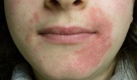 TIPS- Dermatitis Perioral: Apa Penyebabnya dan Bagaimana Cara Mengatasinya dengan Tepat? (Sumber: https://www.alodokter.com/)