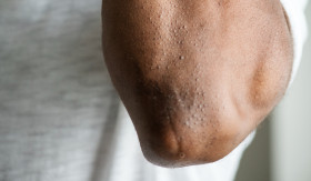 ATASI LUTUT DAN SIKU HITAM - Cara mengatasi lutut dan siku yang hitam. cukup dua bahan saja. - Foto ilustrasi/rawpixel.com.