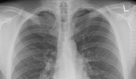 PNEMONIA - Penyakit pneumonia harus segera mendapatkan penanganan medis yang tepat, berikut gejalanya. -Foto ilustrasi Pixabay/oracast.