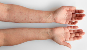 EKSIM DAN PSORIASIS - Eksim dan psoriasis, penyakit kulit yang terlihat sama namun ternyata berbeda. -Foto ilustrasi/freepik