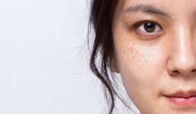 INFO- Rahasia Glowing! Kenali Ciri-Ciri Flek Hitam di Wajah (Sumber: https://www.alodokter.com/)