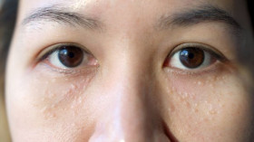 INFO- Milia di Area Mata: Penyebab, Solusi, dan Cara Pemakaian Eye Serum yang Tepat (Sumber: https://www.alodokter.com/)