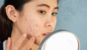 TIPS- Rahasia Tersembunyi Hilangkan Flek Hitam dengan Sisteamin: Mitos atau Solusi? (sumber: https://www.alodokter.com/)