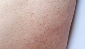 TIPS- Cara Efektif Mengatasi Keratosis Pilaris: Tips untuk Kulit Lebih Halus (sumber: https://www.alodokter.com/)