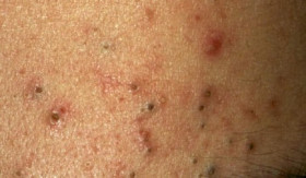 TIPS- Rahasia Kulit Mulus: Cara Efektif Menghilangkan Bekas Jerawat Lama (Sumber: https://www.alodokter.com/)