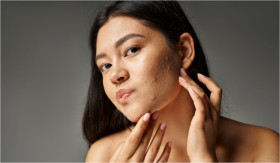 TIPS- Tetap Cantik Saat Berjerawat: Rahasia Makeup dan Perawatan Kulit Acne-Prone (Sumber: https://www.alodokter.com/)