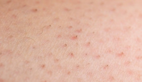 TIPS- Bebas Rambut Tumbuh ke Dalam: Solusi Nyaman untuk Kulit Halus dengan IPL (Sumber: https://www.alodokter.com/)