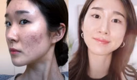 ATASI JERAWAT - Jerawat yang muncul, khususnya pada area wajah, dapat membuat seseorang tidak percaya diri. Seorang wanita bagikan tips atasi jerawat yang jarang dibahas. - Foto tangkap layar YouTube/Kyucumber.