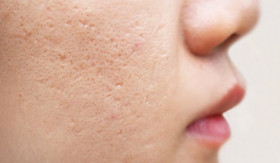 TIPS- Bopeng Tipis atau Pori Besar? Begini Cara Tepat Menanganinya! (Sumber: https://www.alodokter.com/)