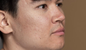 SKINCARE BOPENG - Beli skincare untuk bopeng, hanya buang-buang uang. Sebaiknya lakukan hal ini. - Foto ilustrasi/freepik.