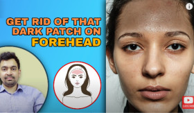 HILANGKAN TANDA HITAM DI DAHI - Sebagian orang muncul tanda hitam di bagian tertentu, contohnya dahi. Apakah ini adalah hal wajar dan bisa diobati? Simak penjelasannya. - Foto tangkap layar YouTube/doctors-circle.