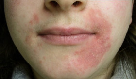 TIPS- Dermatitis Perioral: Penyebab, Risiko Krim Steroid, dan Cara Mengatasinya dengan Tepat! (Sumber: https://www.alodokter.com/)